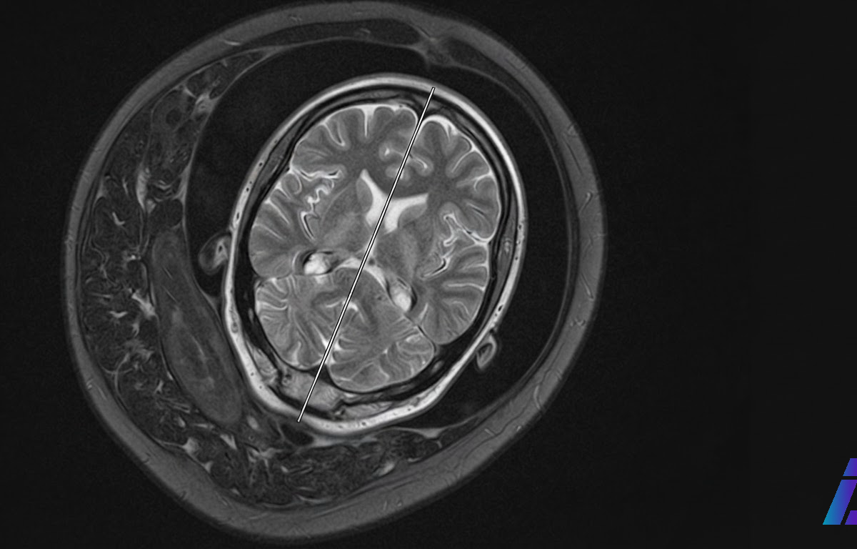Fatia de ressonância magnética em tons de cinza mostrando o cérebro de um feto dentro do útero, com uma linha fina vertical marcando o eixo de simetria entre os hemisférios esquerdo e direito